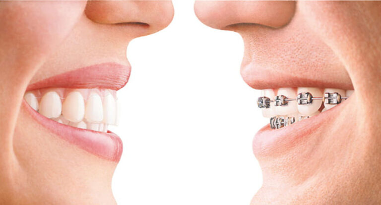 How Long Does Invisalign Treatment Take?